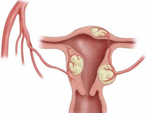 Миома матки современные методы лечения