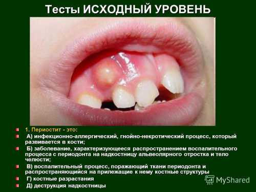 Периостит зуба нижней и верхней челюсти серозный, гнойный