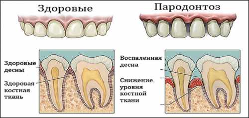 Усиливается чувствительность зубов и десен к внешним раздражителям