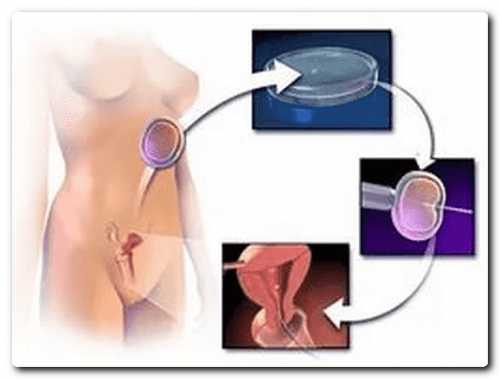 ИКСИ оплодотворение