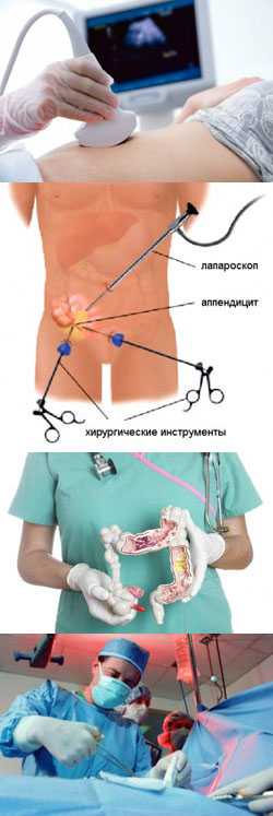 Хронический аппендицит диагностика и лечение